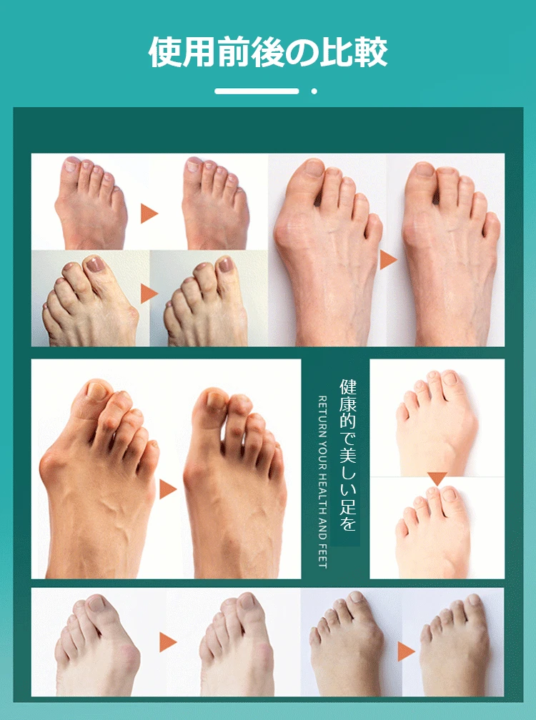 【日本骨科醫生推薦】Tenicore獨家3D旋調整骨拇指外翻矯正器， 科學矯正不傷骨 - 11