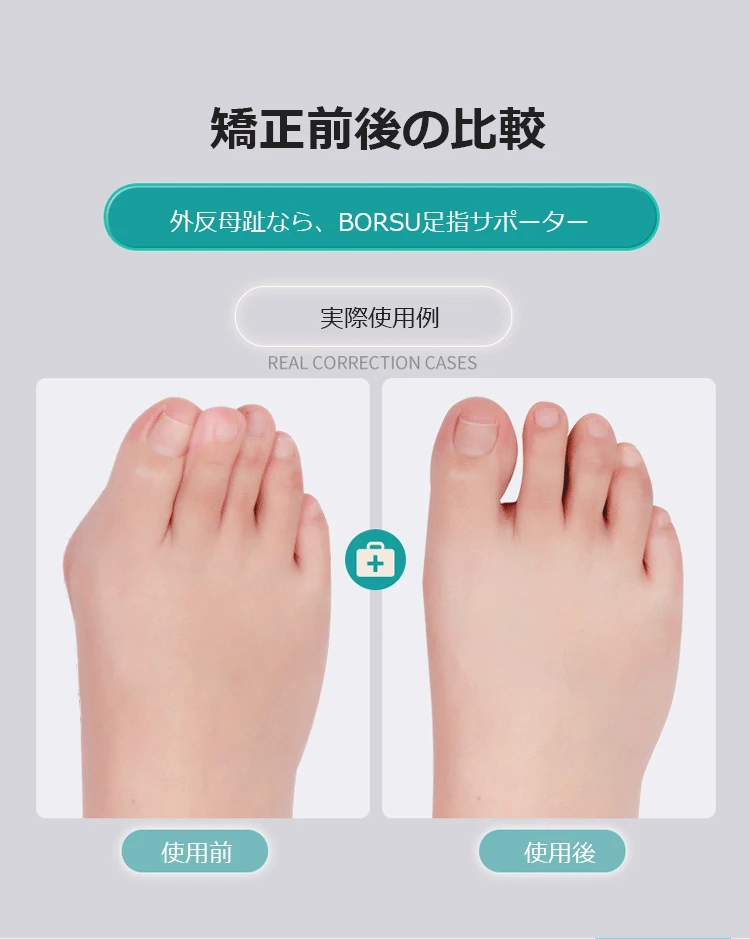 【日本骨科醫生推薦】Tenicore獨家3D旋調整骨拇指外翻矯正器， 科學矯正不傷骨 - 17